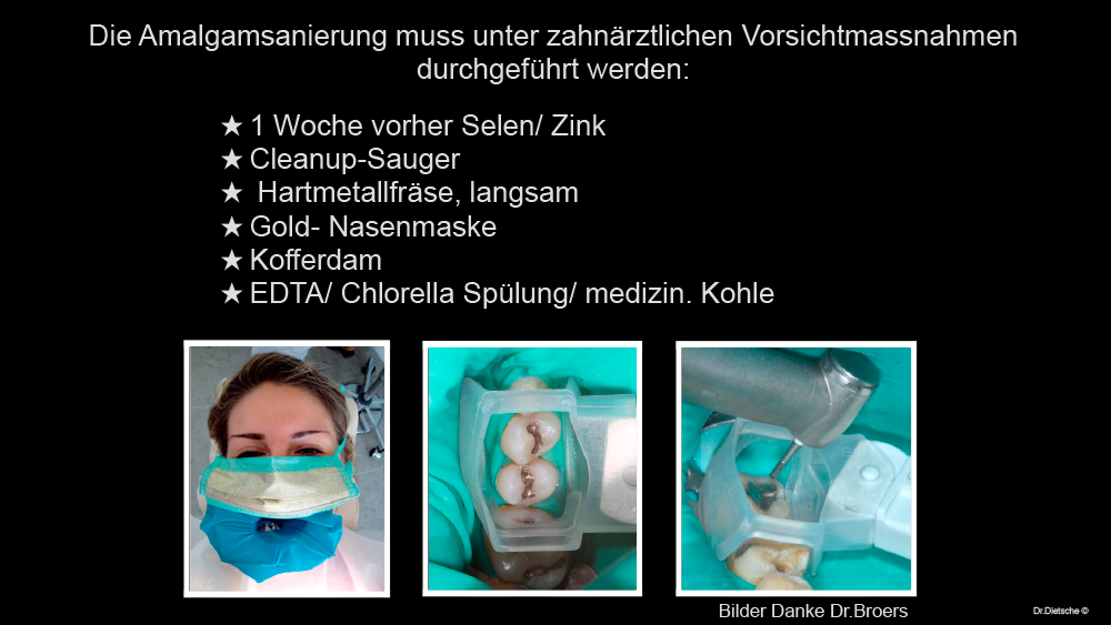 Grafik mit Tipps zur Amalgamentfernung