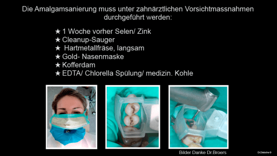 Grafik mit Tipps zur Amalgamentfernung