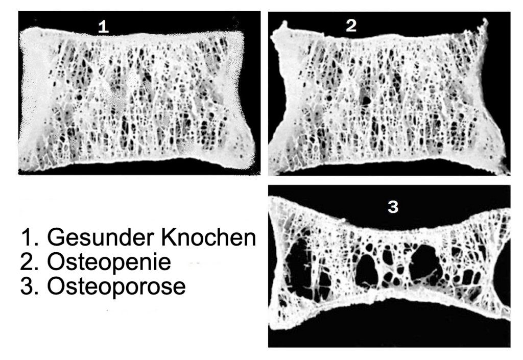Das Bild zeigt Entwicklungsstadien einer Osteoporose (Knochendichteveränderungen) bei einem Wirbelkörper